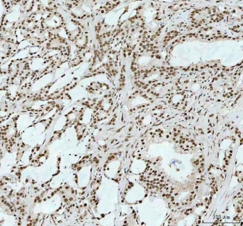 IHC staining of FFPE human prostate cancer tissue with RNA-binding motif protein 3 antibody. HIER: boil tissue sections in pH8 EDTA for 20 min and allow to cool before testing.