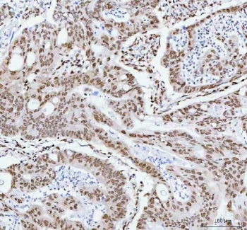 IHC staining of FFPE human colorectal adenocarcinoma tissue with RNA-binding motif protein 3 antibody. HIER: boil tissue sections in pH8 EDTA for 20 min and allow to cool before testing.
