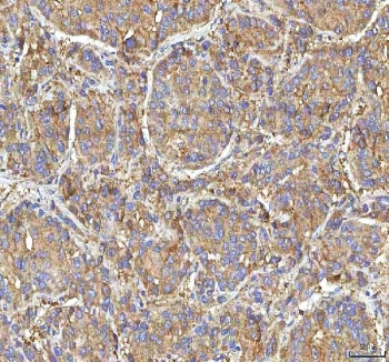 IHC staining of FFPE human liver cancer tissue with GOLGA7 antibody. HIER: boil tissue sections in pH8 EDTA for 20 min and allow to cool before testing.