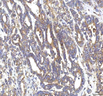 IHC staining of FFPE human ovarian cancer tissue with GOLGA7 antibody. HIER: boil tissue sections in pH8 EDTA for 20 min and allow to cool before testing.