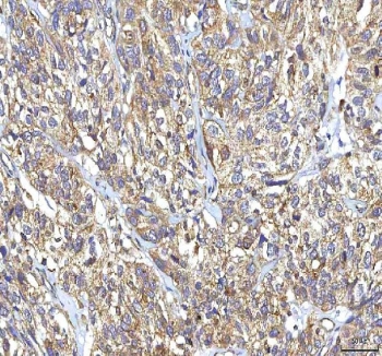 IHC staining of FFPE human urothelial carcinoma tissue with GOLGA7 antibody. HIER: boil tissue sections in pH8 EDTA for 20 min and allow to cool before testing.