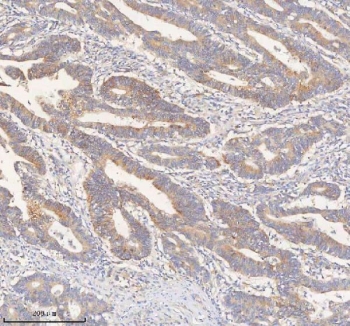 HER4 Antibody Human Colon Adenocarcinoma Tissue IHC. Immunohistochemistry staining of FFPE human colon adenocarcinoma tissue with HER4 antibody. HIER: boil tissue sections in pH8 EDTA for 20 min and allow to cool before testing.