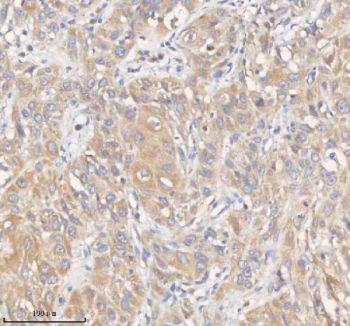 HER4 Antibody Human Urothelial Carcinoma Tissue IHC. Immunohistochemistry staining of FFPE human urothelial carcinoma tissue with HER4 antibody. HIER: boil tissue sections in pH8 EDTA for 20 min and allow to cool before testing.