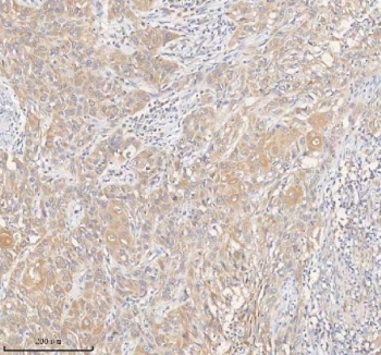 HER4 Antibody Urothelial Carcinoma IHC. Immunohistochemistry staining of FFPE human urothelial carcinoma tissue with HER4 antibody. HIER: boil tissue sections in pH8 EDTA for 20 min and allow to cool before testing.