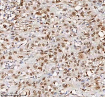 IHC staining of FFPE human urothelial carcinoma tissue with MACROH2A1 antibody. HIER: boil tissue sections in pH8 EDTA for 20 min and allow to cool before testing.