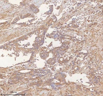 IHC staining of FFPE human pancreas ductal adenocarcinoma tissue with ITPRIP antibody. HIER: boil tissue sections in pH8 EDTA for 20 min and allow to cool before testing.