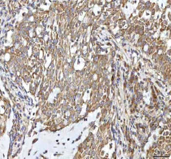 IHC staining of FFPE human lung cancer tissue with Oncomodulin 1 antibody. HIER: boil tissue sections in pH8 EDTA for 20 min and allow to cool before testing.