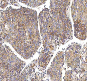 IHC staining of FFPE human liver cancer tissue with Oncomodulin 1 antibody. HIER: boil tissue sections in pH8 EDTA for 20 min and allow to cool before testing.