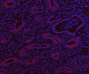 Immunofluorescent staining of FFPE human intestinal cancer tissue with HSDL2 antibody (red) and DAPI nuclear stain (blue). HIER: steam section in pH8 EDTA buffer for 20 min.
