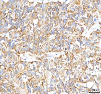 IHC staining of FFPE human urothelial carcinoma tissue with HSDL2 antibody. HIER: boil tissue sections in pH8 EDTA for 20 min and allow to cool before testing.