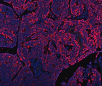 Immunofluorescent staining of FFPE human ovarian cancer tissue with Peptide deformylase antibody (red) and DAPI nuclear stain (blue). HIER: steam section in pH8 EDTA buffer for 20 min.