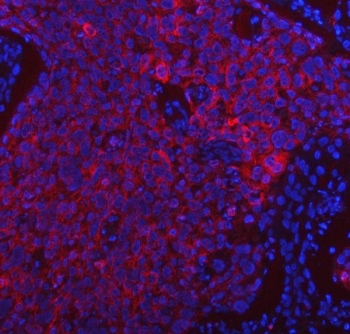 Immunofluorescent staining of FFPE human esophageal squamous cell carcinoma tissue with Peptide deformylase antibody (red) and DAPI nuclear stain (blue). HIER: steam section in pH8 EDTA buffer for 20 min.