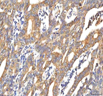 IHC staining of FFPE human colon adenocarcinoma tissue with Peptide deformylase antibody. HIER: boil tissue sections in pH8 EDTA for 20 min and allow to cool before testing.