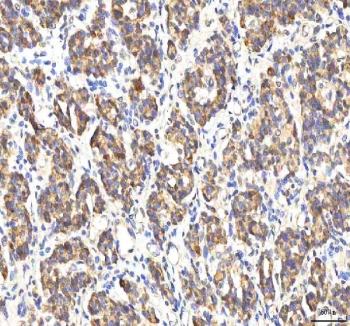 IHC staining of FFPE human lung cancer tissue with Peptide deformylase antibody. HIER: boil tissue sections in pH8 EDTA for 20 min and allow to cool before testing.