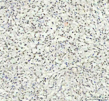 Phospho-AKT1 (pT450) Antibody Lymphoma Tissue IHC. Immunohistochemistry of FFPE human intestinal diffuse large B-cell lymphoma tissue using phospho-AKT1 (pT450) antibody shows HRP-DAB brown cytoplasmic and nuclear staining in malignant lymphoid cells, consistent with activated PI3K-AKT signaling and phosphorylation at the T450 turn motif, while surrounding stromal elements display lower background; clone HEA-1 was used for detection. HIER: boil tissue sections in pH8 EDTA for 20 min and allow to cool before testing.