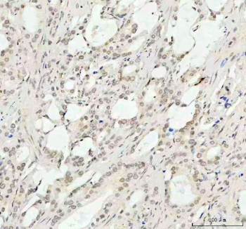 Phospho-AKT1 (pT450) Antibody Prostate Cancer Tissue IHC. Immunohistochemistry of FFPE human prostate carcinoma tissue using phospho-AKT1 (pT450) antibody shows HRP-DAB brown cytoplasmic and nuclear staining in tumor epithelial cells, consistent with phosphorylation at the T450 turn motif and active PI3K-AKT signaling, while surrounding stromal components display lower background; detection was performed with clone HEA-1. HIER: boil tissue sections in pH8 EDTA for 20 min and allow to cool before testing.