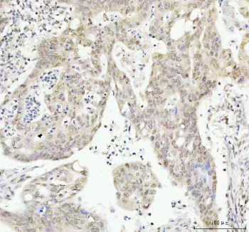 Phospho-AKT1 (pT450) Antibody Colorectal Adenocarcinoma IHC. Immunohistochemistry of FFPE human colorectal adenocarcinoma tissue using phospho-AKT1 (pT450) antibody shows HRP-DAB brown cytoplasmic and nuclear staining in tumor epithelial cells, consistent with phosphorylation at the T450 turn motif and active PI3K-AKT signaling, while adjacent stromal regions display lower background; detection was performed with clone HEA-1. HIER: boil tissue sections in pH8 EDTA for 20 min and allow to cool before testing.