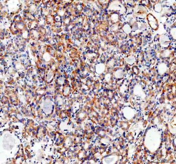 IHC staining of FFPE human thyroid cancer tissue with SLC39A10 antibody, HRP-secondary and DAB substrate. HIER: boil tissue sections in pH8 EDTA for 20 min and allow to cool before testing.