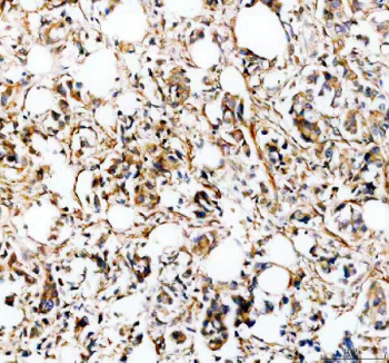 IHC staining of FFPE human breast cancer tissue with SLC39A10 antibody, HRP-secondary and DAB substrate. HIER: boil tissue sections in pH8 EDTA for 20 min and allow to cool before testing.