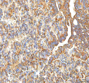 IHC staining of FFPE human thyroid papillary carcinoma tissue with XDH antibody. HIER: boil tissue sections in pH8 EDTA for 20 min and allow to cool before testing.