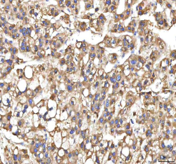 IHC staining of FFPE human liver cancer tissue with XDH antibody. HIER: boil tissue sections in pH8 EDTA for 20 min and allow to cool before testing.