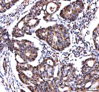 IHC staining of FFPE human colon adenocarcinoma tissue with IPO9 antibody. HIER: boil tissue sections in pH8 EDTA for 20 min and allow to cool before testing.