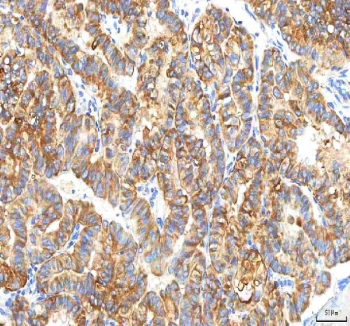 IHC staining of FFPE human thyroid papillary carcinoma tissue with PFKP antibody. HIER: boil tissue sections in pH8 EDTA for 20 min and allow to cool before testing.