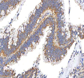IHC staining of FFPE human colon adenocarcinoma tissue with PFKP antibody. HIER: boil tissue sections in pH8 EDTA for 20 min and allow to cool before testing.