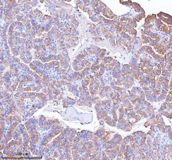 IHC staining of FFPE human thyroid papillary carcinoma tissue with MLKL antibody. HIER: boil tissue sections in pH8 EDTA for 20 min and allow to cool before testing.
