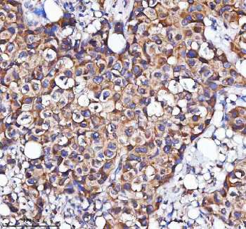 IHC staining of FFPE human breast cancer tissue with MLKL antibody. HIER: boil tissue sections in pH8 EDTA for 20 min and allow to cool before testing.
