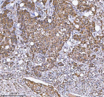 IHC staining of FFPE human breast cancer tissue with MLKL antibody. HIER: boil tissue sections in pH8 EDTA for 20 min and allow to cool before testing.