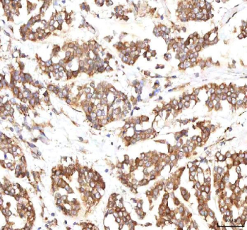 IHC staining of FFPE human breast cancer tissue with INTU antibody. HIER: boil tissue sections in pH8 EDTA for 20 min and allow to cool before testing.