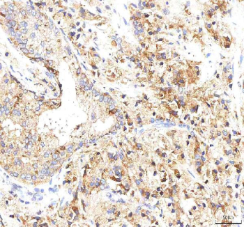 IHC staining of FFPE human prostate cancer tissue with INTU antibody. HIER: boil tissue sections in pH8 EDTA for 20 min and allow to cool before testing.