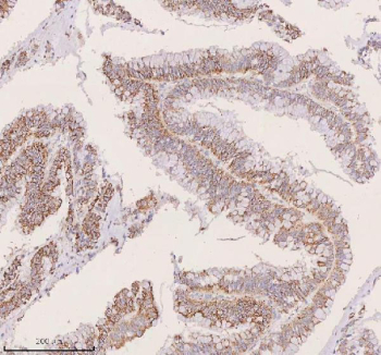 IHC staining of FFPE human human colon adenocarcinoma tissue with IRS4 antibody. HIER: boil tissue sections in pH8 EDTA for 20 min and allow to cool before testing.