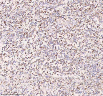IHC staining of FFPE diffuse large B-cell lymphoma of human intestine tissue with IRS4 antibody. HIER: boil tissue sections in pH8 EDTA for 20 min and allow to cool before testing.