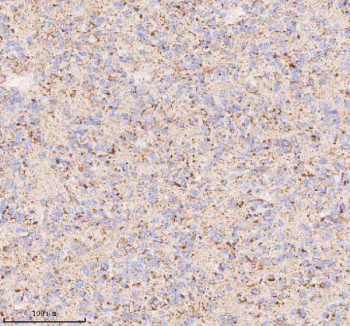 IHC staining of FFPE human glioblastoma tissue with IRS4 antibody. HIER: boil tissue sections in pH8 EDTA for 20 min and allow to cool before testing.