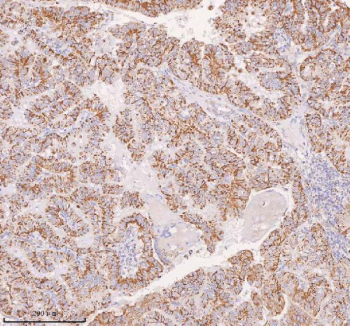 IHC staining of FFPE human thyroid papillary carcinoma tissue with IRS4 antibody. HIER: boil tissue sections in pH8 EDTA for 20 min and allow to cool before testing.