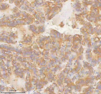 IHC staining of FFPE human thyroid papillary carcinoma tissue with SLK antibody. HIER: boil tissue sections in pH8 EDTA for 20 min and allow to cool before testing.