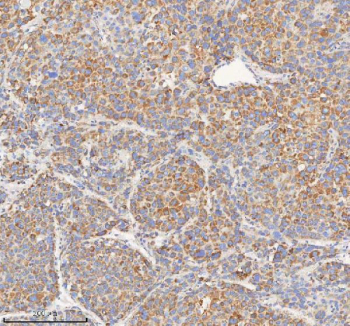 IHC staining of FFPE human liver cancer tissue with HADHB antibody. HIER: boil tissue sections in pH8 EDTA for 20 min and allow to cool before testing.