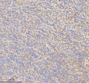 IHC staining of FFPE human glioblastoma tissue with HADHB antibody. HIER: boil tissue sections in pH8 EDTA for 20 min and allow to cool before testing.