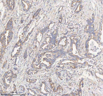 IHC staining of FFPE human pancreas ductal adenocarcinoma tissue with HADHB antibody. HIER: boil tissue sections in pH8 EDTA for 20 min and allow to cool before testing.