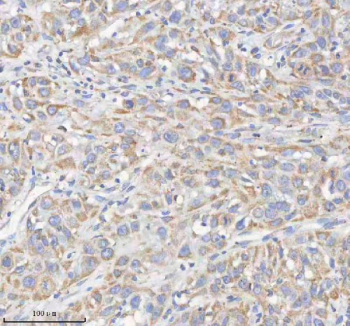 IHC staining of FFPE human urothelial carcinoma tissue with HADHB antibody. HIER: boil tissue sections in pH8 EDTA for 20 min and allow to cool before testing.