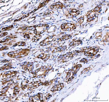 IHC staining of FFPE human gastric adenocarcinoma tissue with PGC antibody. HIER: boil tissue sections in pH8 EDTA for 20 min and allow to cool before testing.