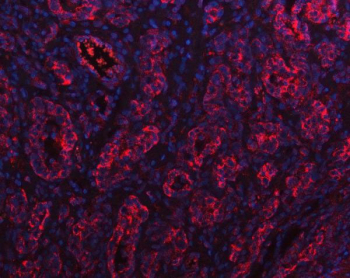 Immunofluorescent staining of FFPE human gastric cancer tissue with PGC antibody (red) and DAPI nuclear stain (blue). HIER: steam section in pH8 EDTA buffer for 20 min.
