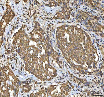 IHC staining of FFPE human lung cancer tissue with SMIM8 antibody. HIER: boil tissue sections in pH8 EDTA for 20 min and allow to cool before testing.