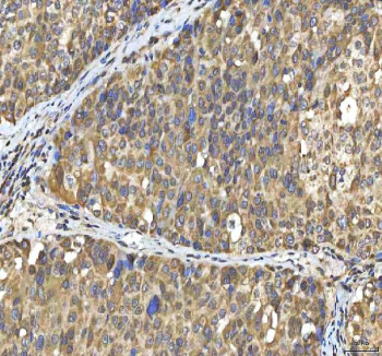 IHC staining of FFPE human liver cancer tissue with SMIM8 antibody. HIER: boil tissue sections in pH8 EDTA for 20 min and allow to cool before testing.