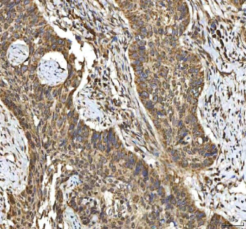 IHC staining of FFPE human laryngeal squamous cell carcinoma tissue with SMIM8 antibody. HIER: boil tissue sections in pH8 EDTA for 20 min and allow to cool before testing.