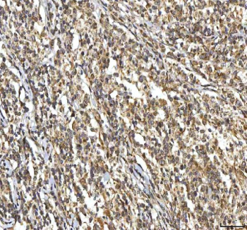 IHC staining of FFPE human diffuse large B cell lymphoma tissue with SMIM8 antibody. HIER: boil tissue sections in pH8 EDTA for 20 min and allow to cool before testing.