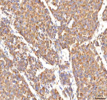 IHC staining of FFPE human liver cancer tissue with MANSC4 antibody. HIER: boil tissue sections in pH8 EDTA for 20 min and allow to cool before testing.