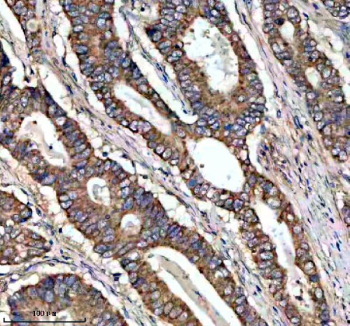 IHC staining of FFPE human stomach cancer tissue with AqCbl reductase antibody, HRP-labeled secondary and DAB substrate. HIER: boil tissue sections in pH8 EDTA for 20 min and allow to cool before testing.